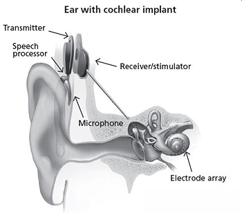 cochlear implant